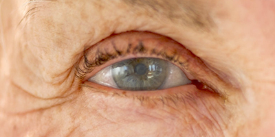 Glaucoma Glaucoma