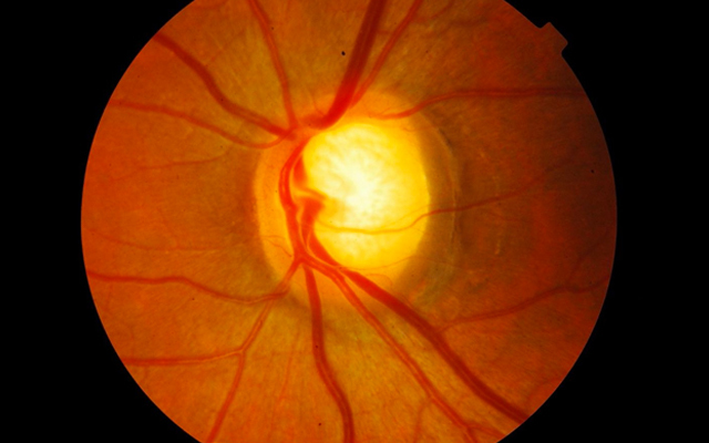 glaucoma glaucoma