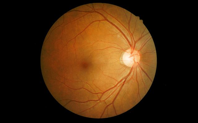 descolamento de retina descolamento de retina